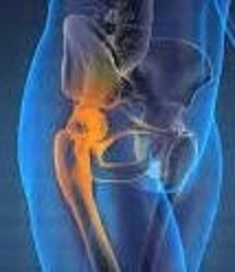right side hip osteoarthritis