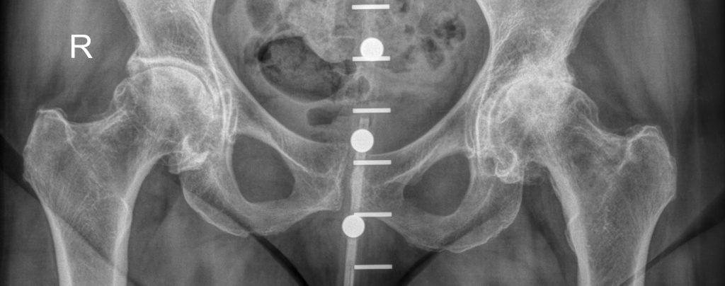 X-ray of my hip